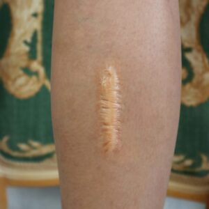 Keloid Scar Silicone Prosthetic (2 x 7 cm) – SFX & Cosplay (7 Skin Tones)