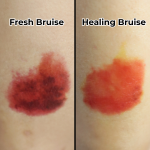 Fresh / Healing Bruise