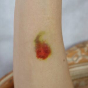 Small Healing Bruise