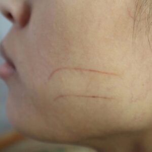 Small Old Cut &  Small Healing Cut