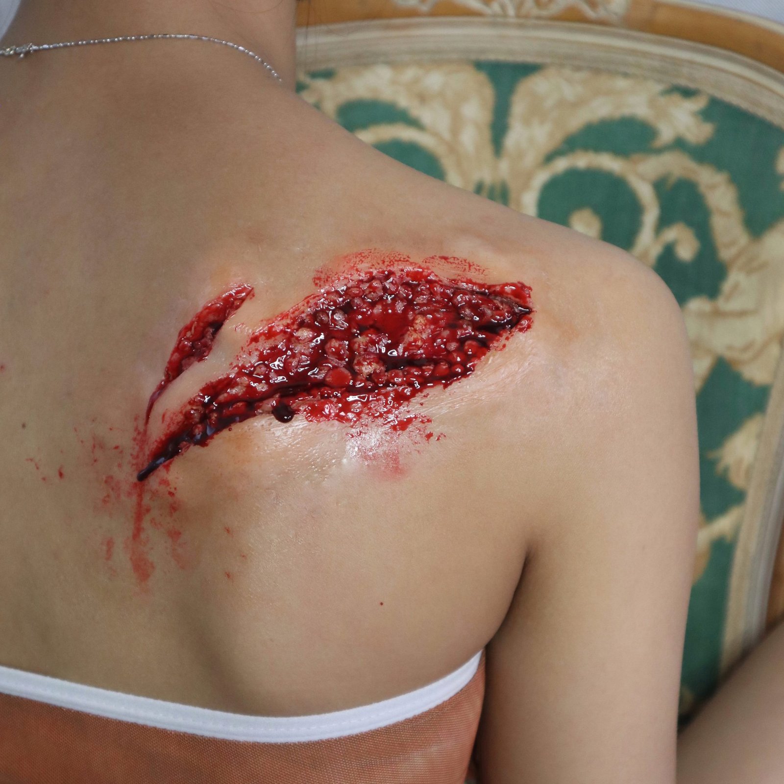 Large Open Wound