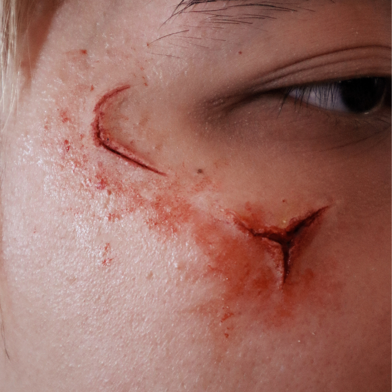 Facial Scarring