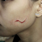 Facial Scarring