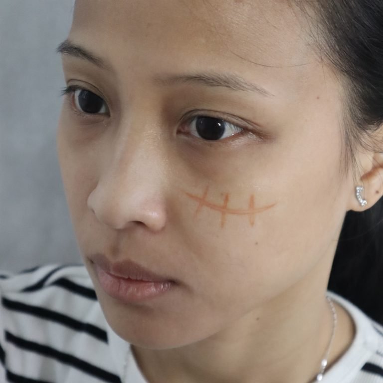Pirate Scar