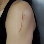 Healed Cut Scarring