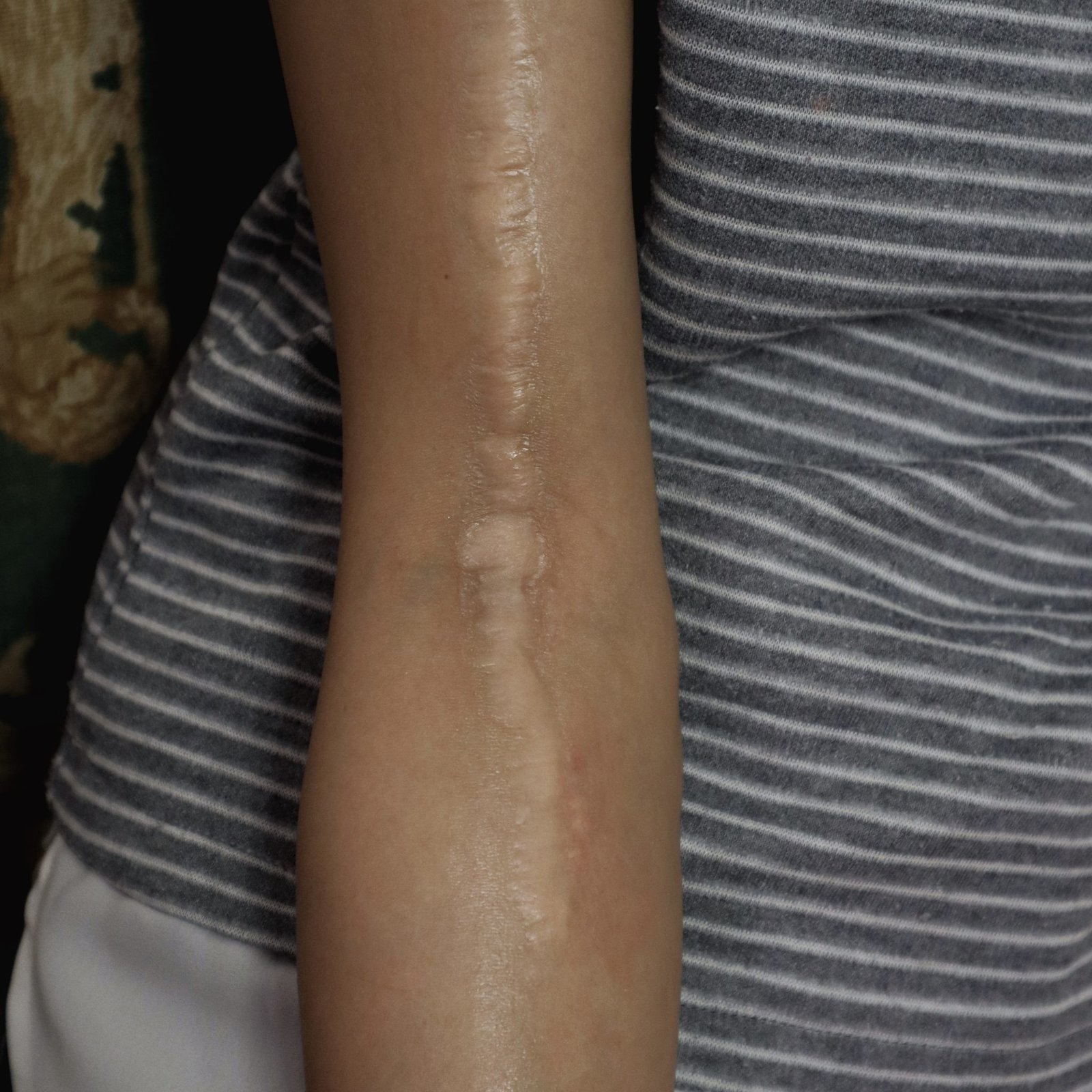 Keloid