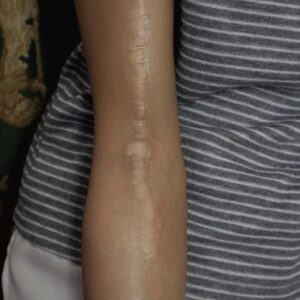 Realistic Keloid Silicone Prosthetic (1.5 x 20 cm) – SFX & Cosplay (7 Skin Tones)