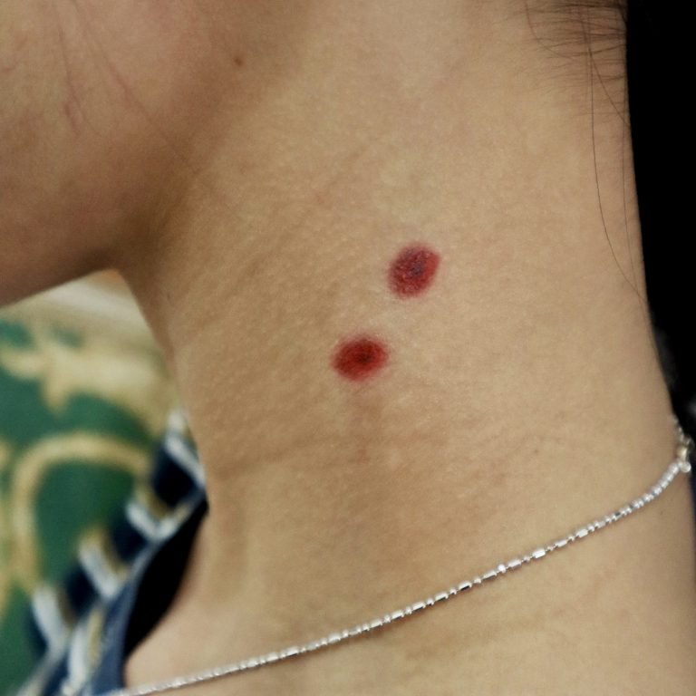 Vampire Bite Wound