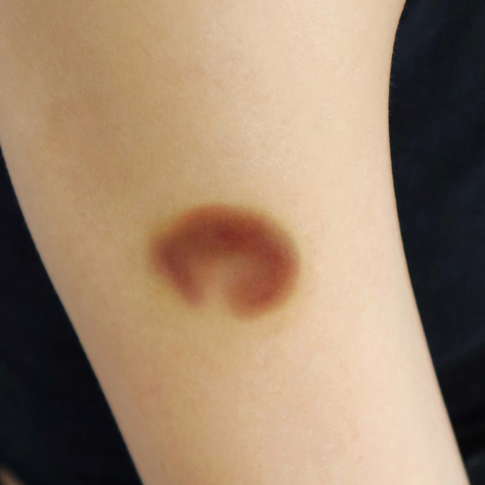 Healing Bruise