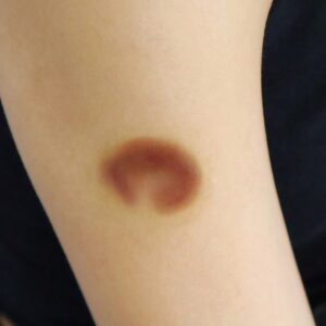 Healing Bruise 11