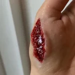 Large Cut Wound Torn