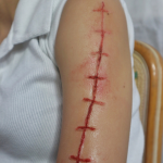 Open Incision