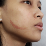 Small Healing Keloid & Old Small Keloid