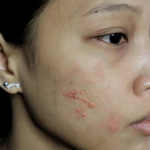 Face Scarring