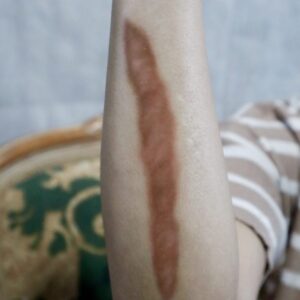 Healed Medium Keloid & Old Medium Keloid SFX – Special Effects Body Art