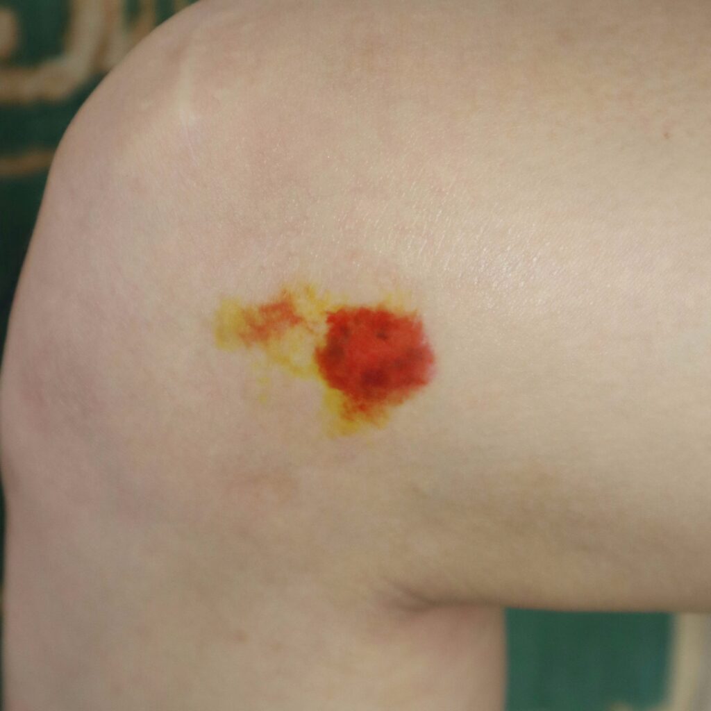 Wounds & Scars