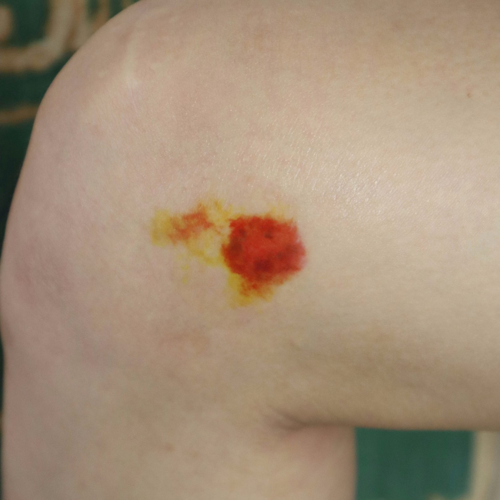 Healing Bruise