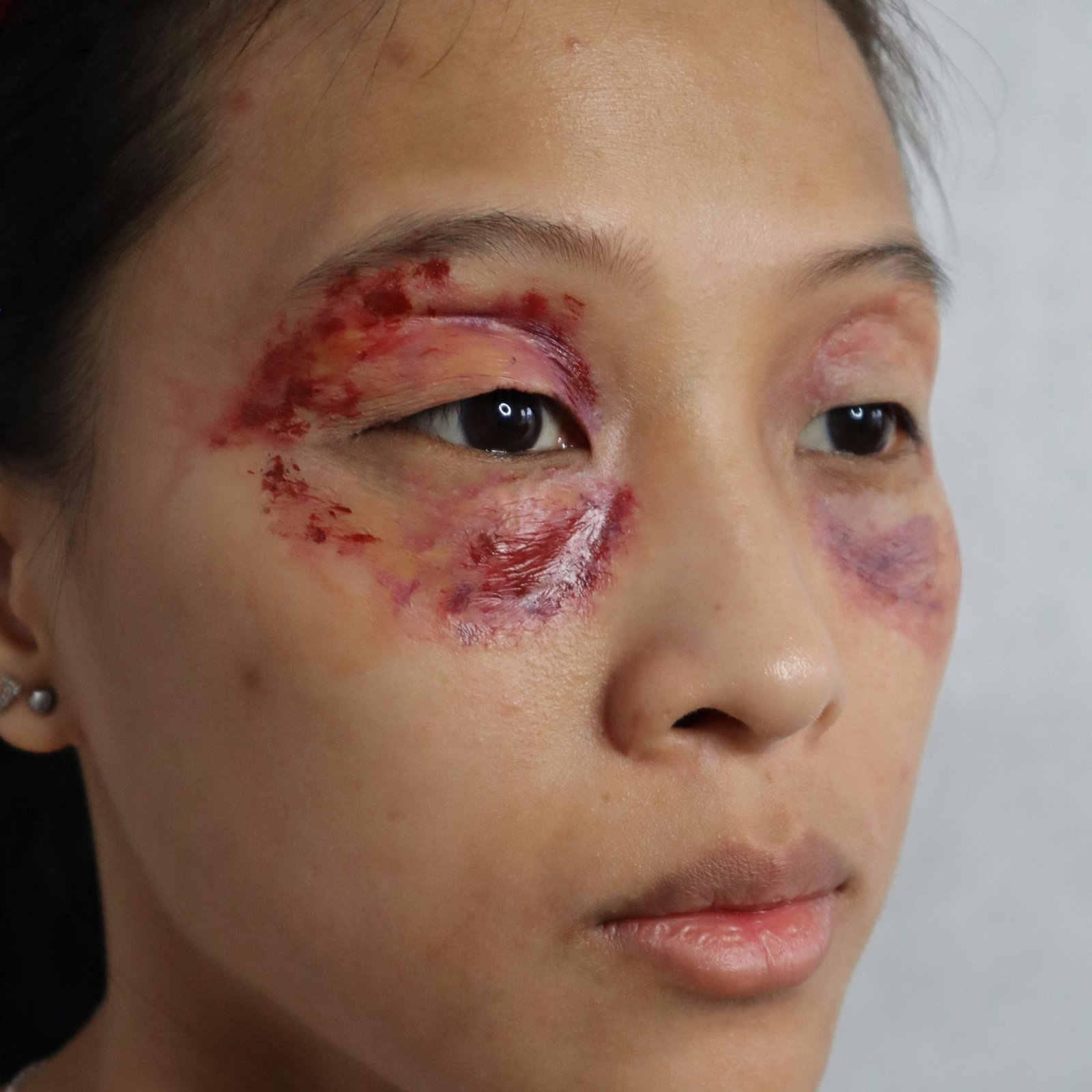 Right/Left Eye Swollen & Bruised