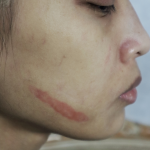 Small Healing Keloid