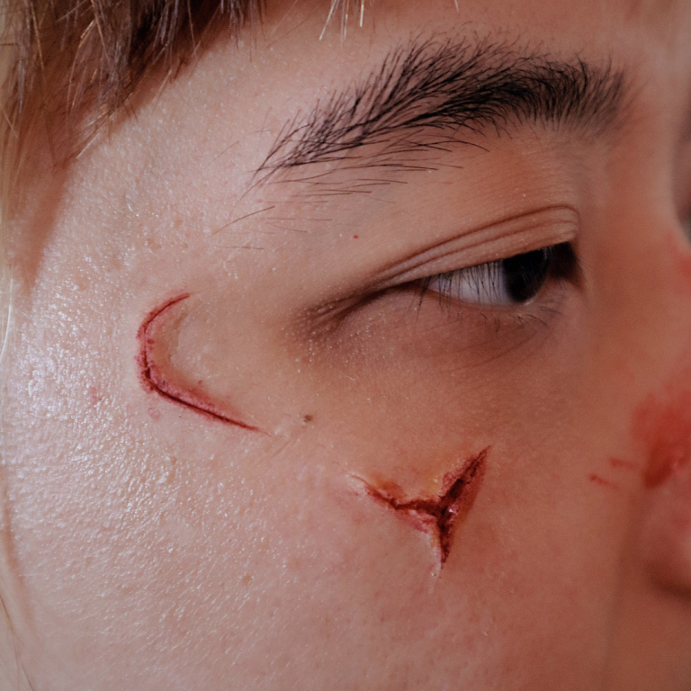 Facial Scarring