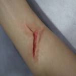 Healed Cut Scarring