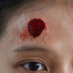 Hammer Wound