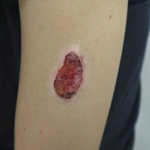 Open Wound