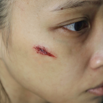 Facial Scarring