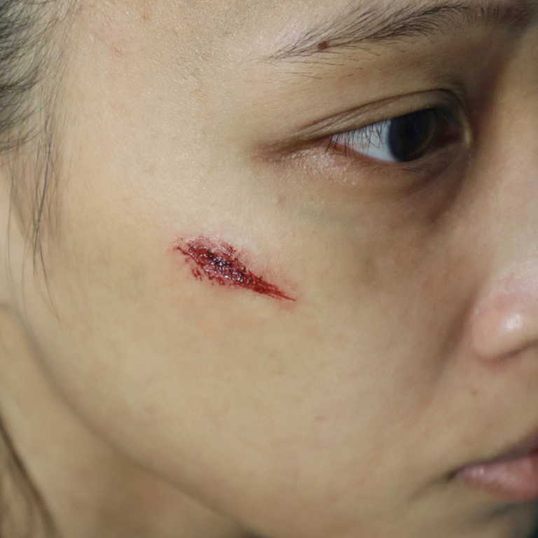 Facial Scarring