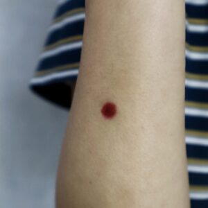 Puncture Wound & Cigar Burn