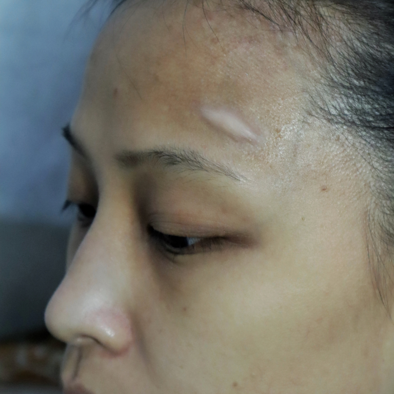 Small & Big Swelling