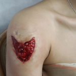 Open Wound
