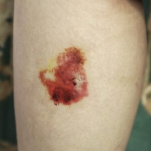 Fresh Bruise