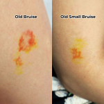 Old Bruise