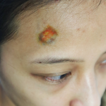 Small Bruise