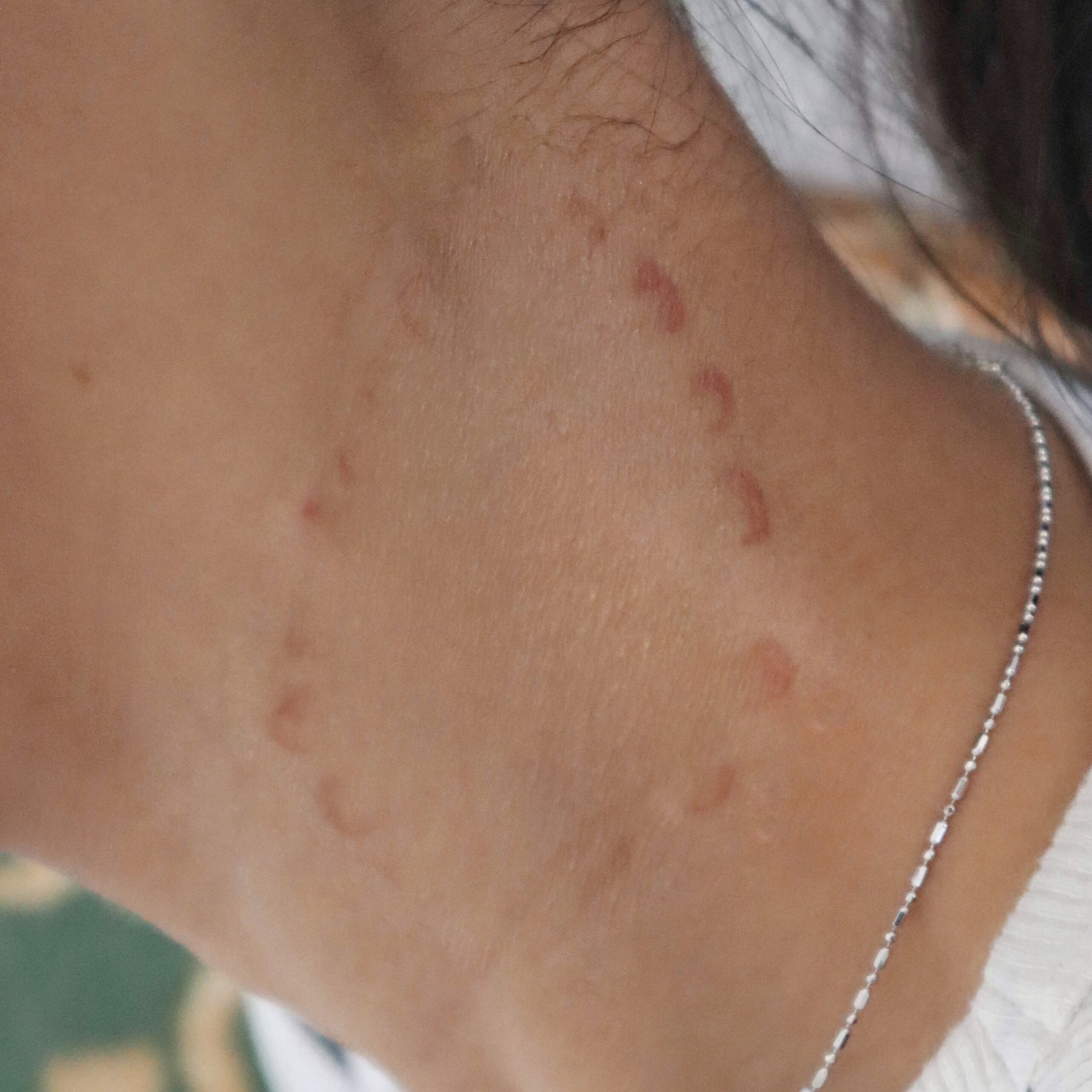 Bite Wound - Image 2