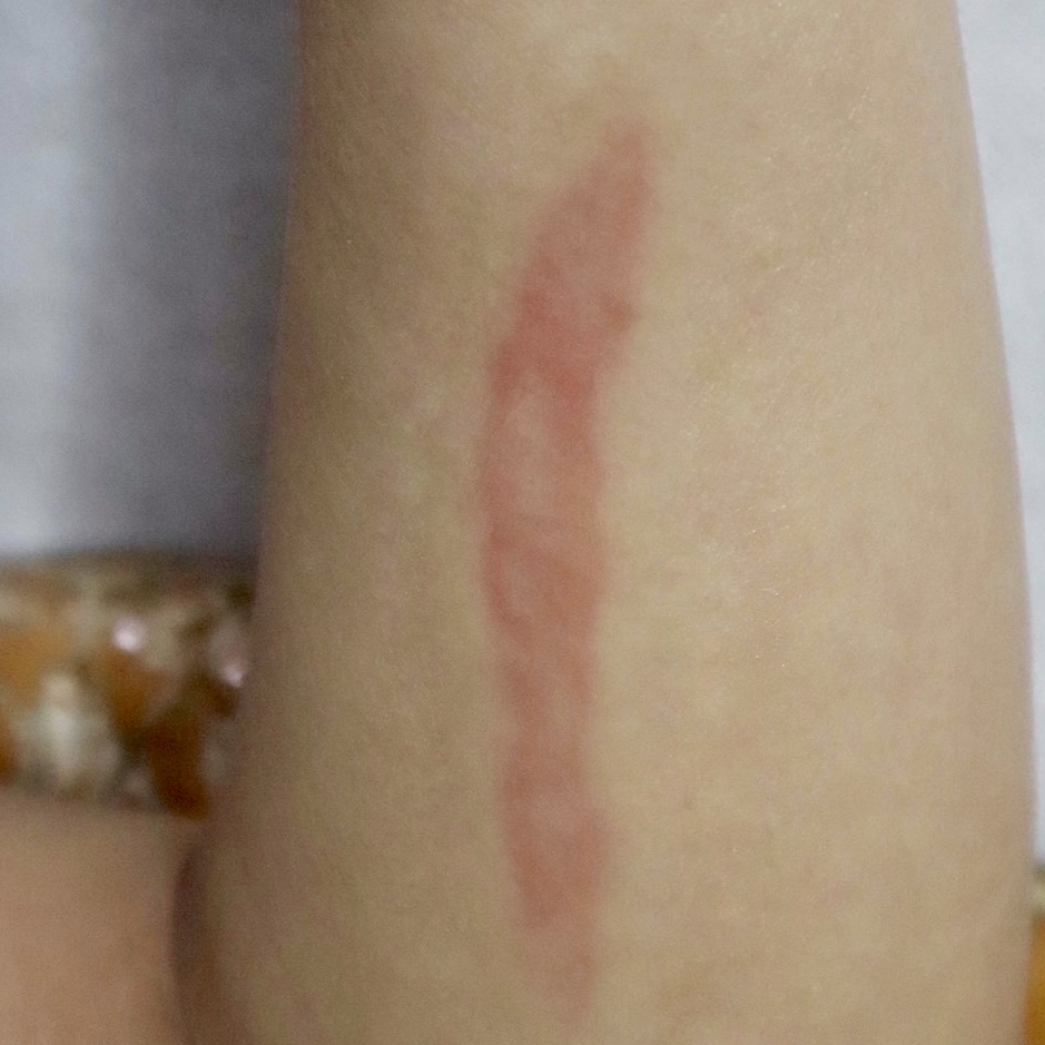 Healing Keloid & Small Healing Keloid - Image 2