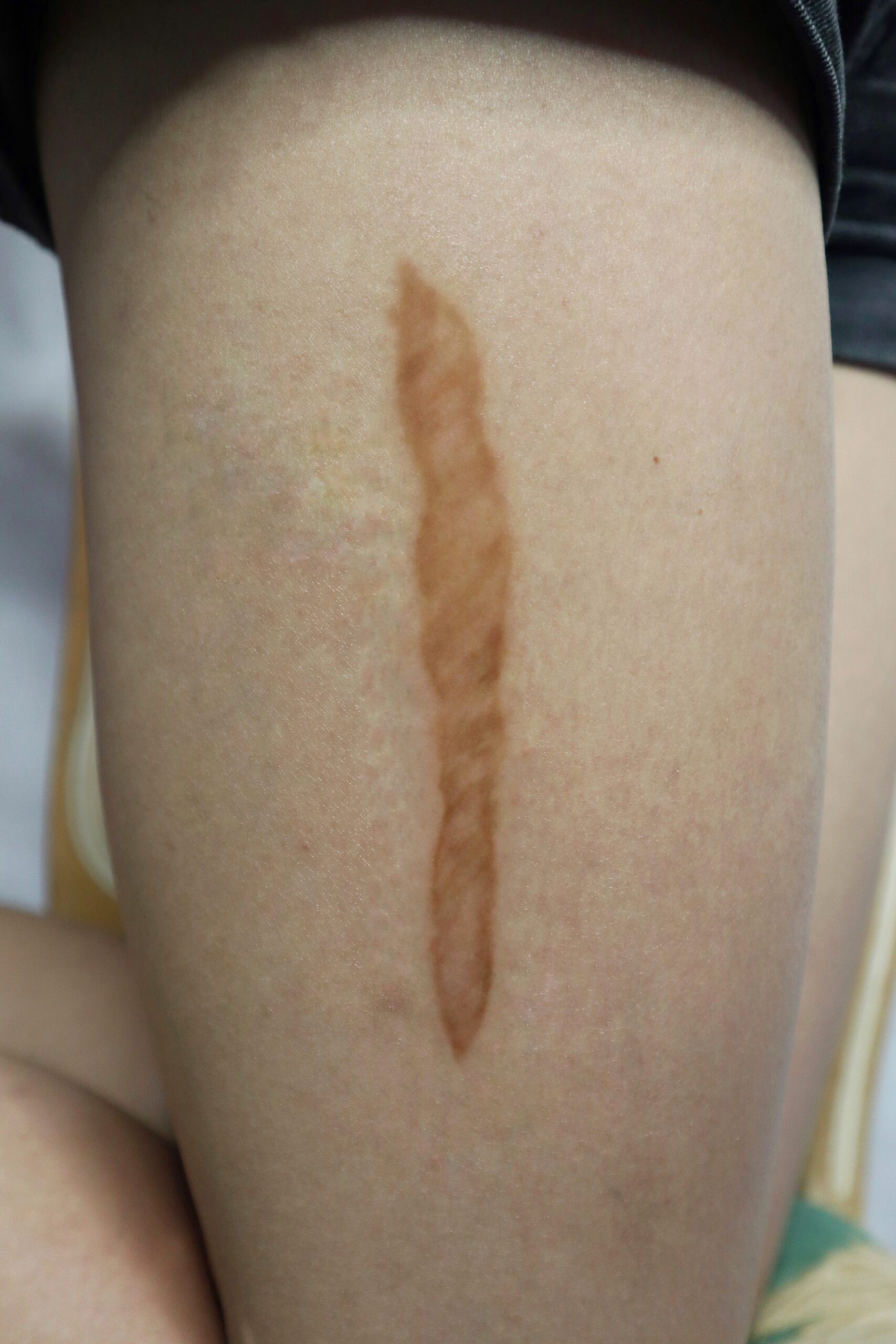 Healed Medium Keloid & Old Medium Keloid SFX โ Special Effects Body Art - Image 2