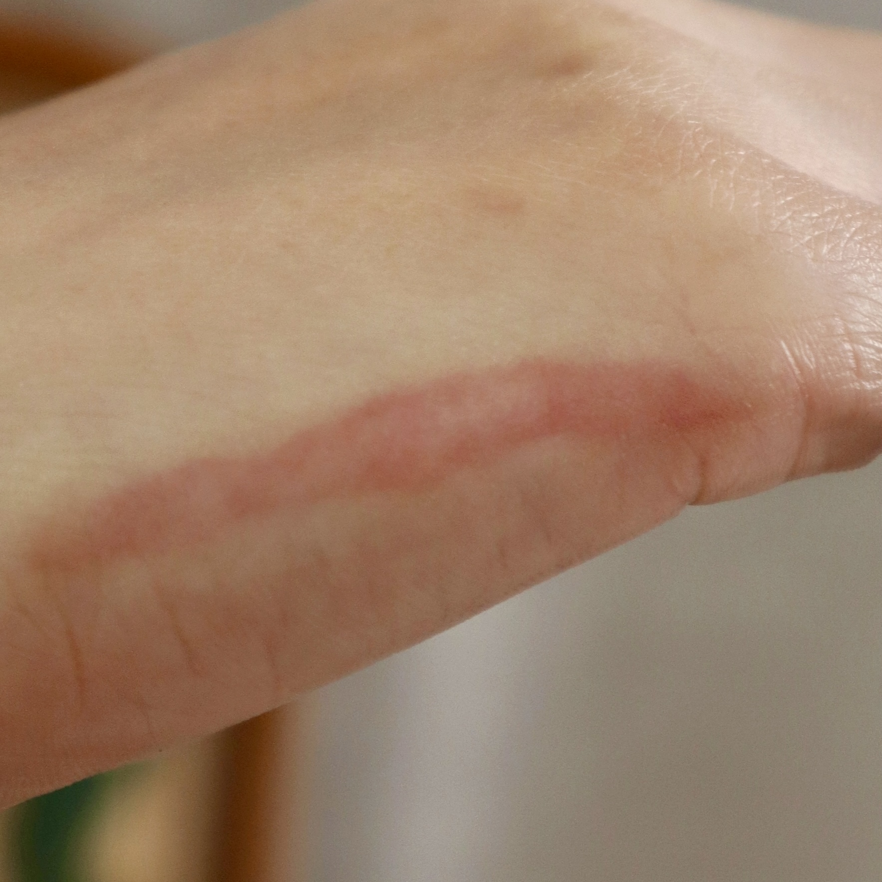 Healing Keloid & Small Healing Keloid - Image 4