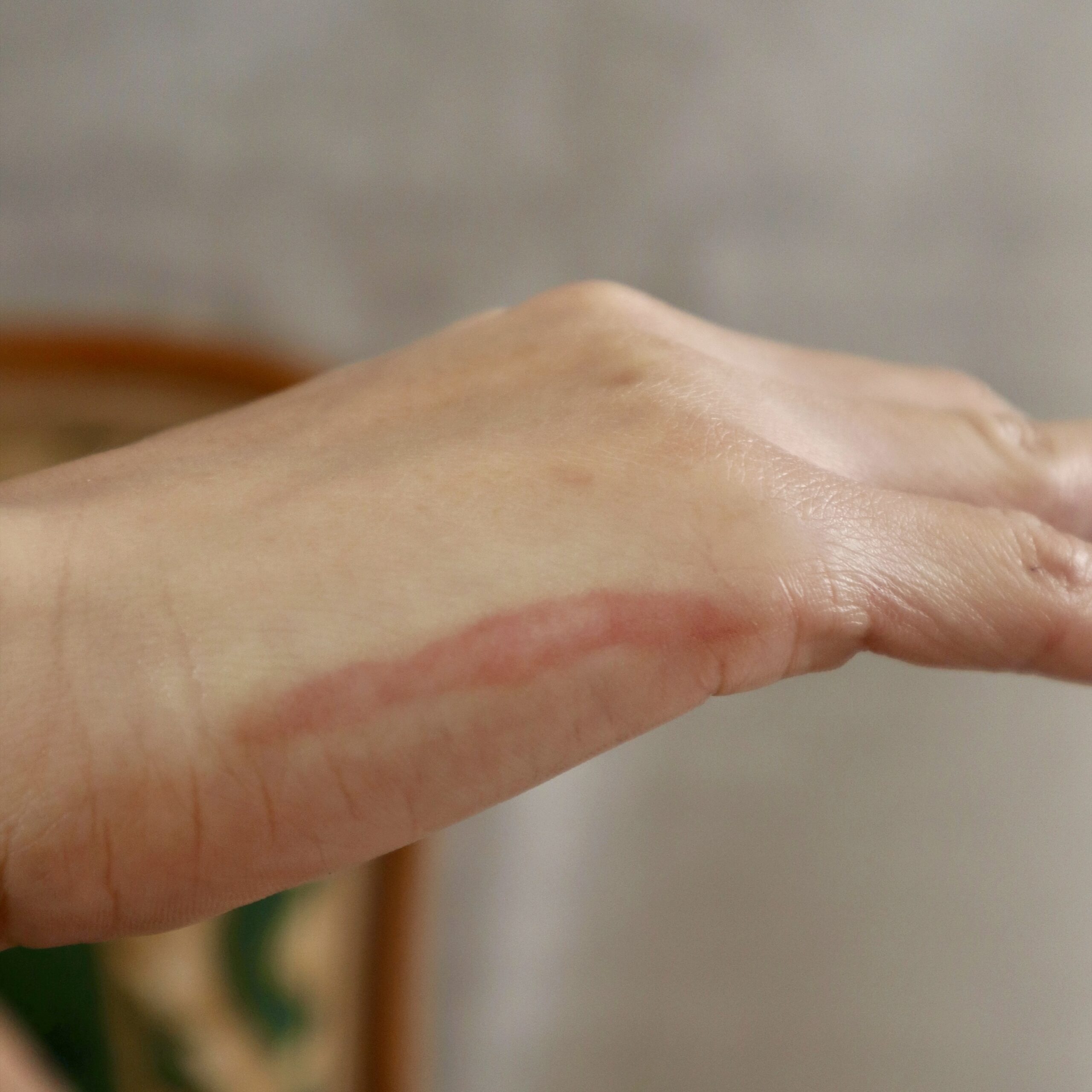 Healing Keloid & Small Healing Keloid - Image 3
