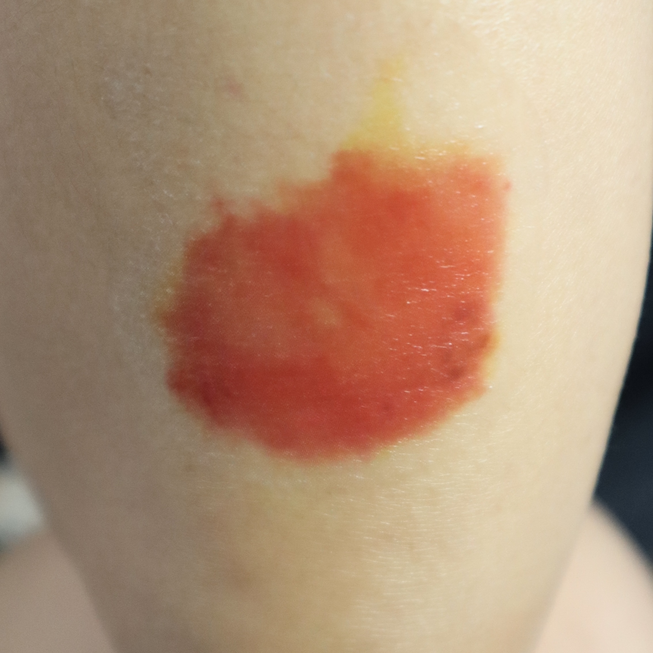 Fresh / Healing Bruise SFX โ Special Effects Body Art - Image 2