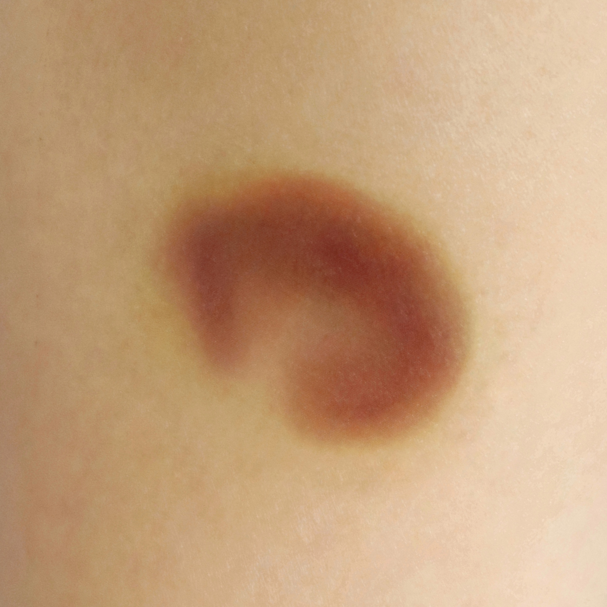 Healing Bruise 11 - Image 2
