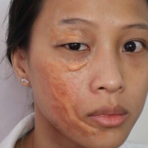 Face Burn Scarring Silicone Prosthetic (Type 7/15) – SFX & Cosplay (7 Skin Tones)