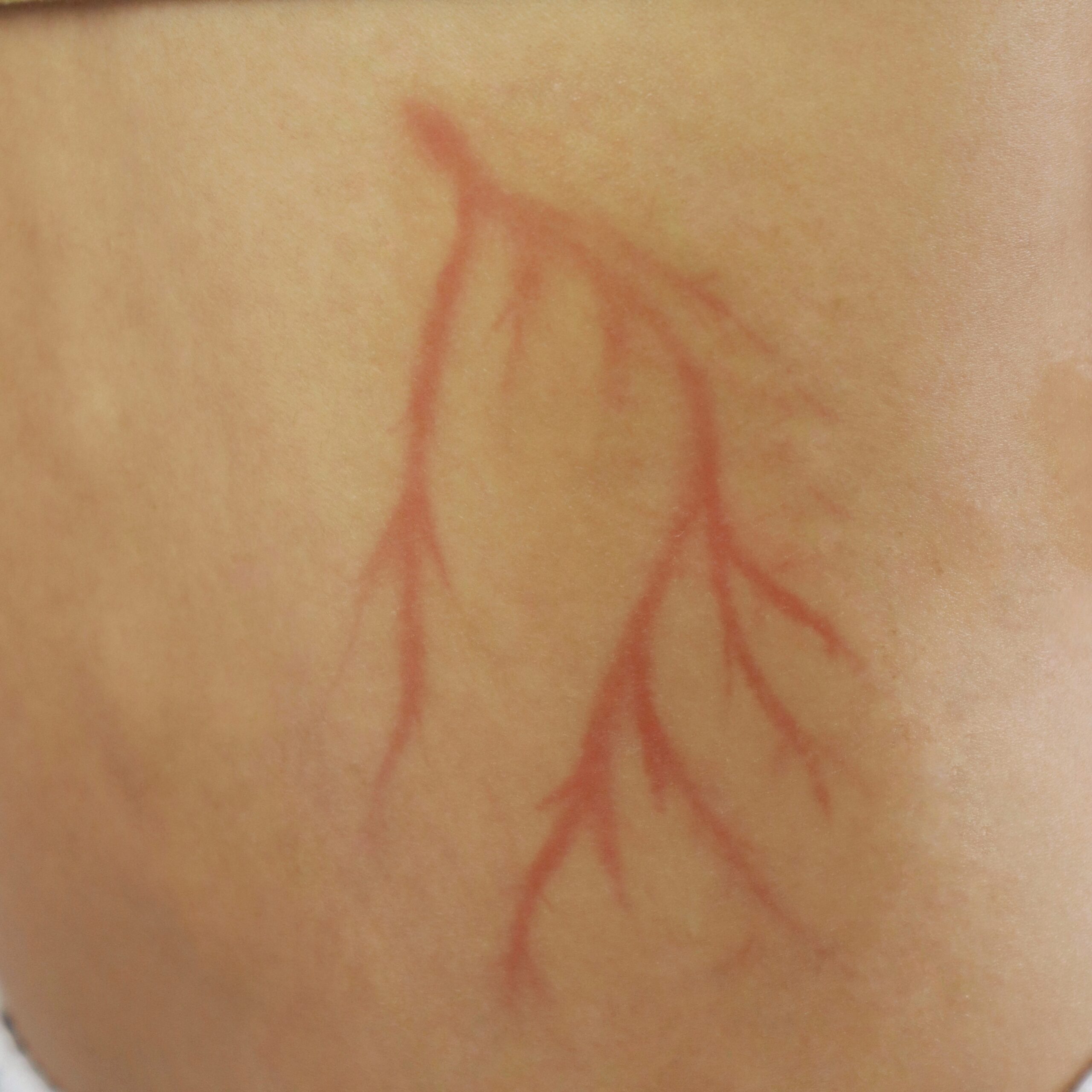 Lichtenberg Vein Type - Image 2