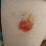 Healing Bruise