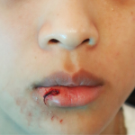 Facial Scarring