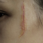 Old Face Scar