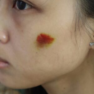 Healing Bruise 13
