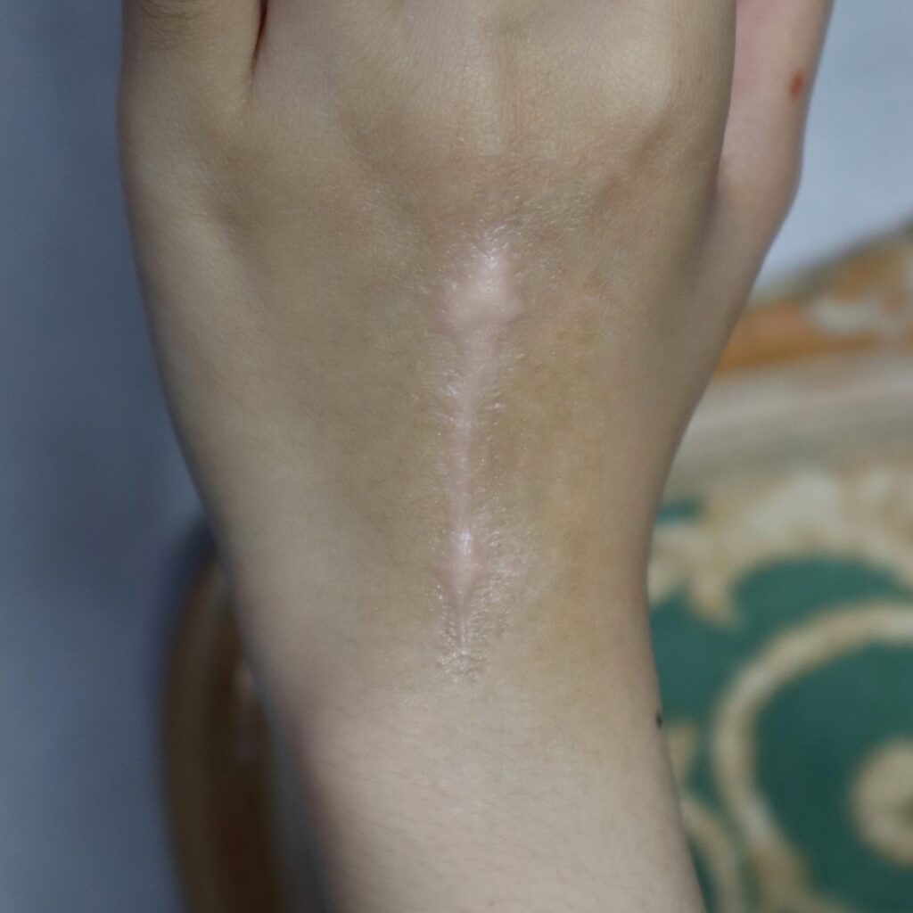 Wounds & Scars