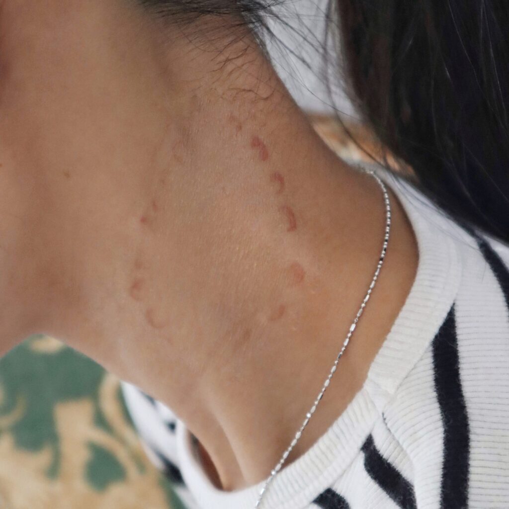 Wounds & Scars